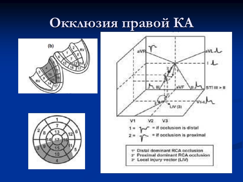 Окклюзия правой КА